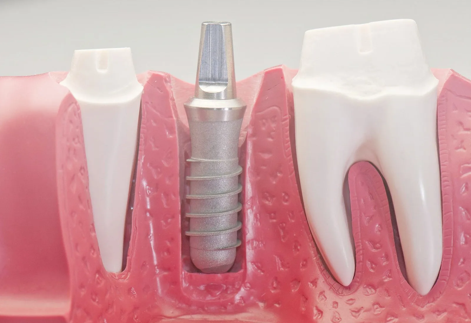 fondo-implantes-dentales